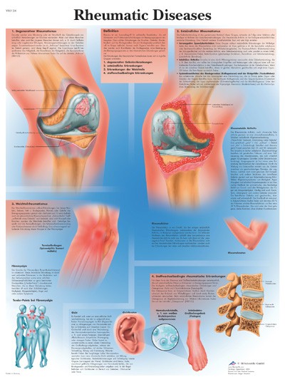 Wandkaart: Rheumatic Diseases