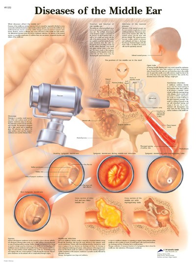 All Products - Diseases Of The Middle Ear